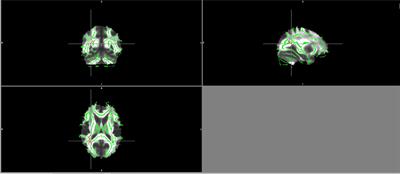 BDNF Serum Levels are Associated With White Matter Microstructure in Schizophrenia - A Pilot Study